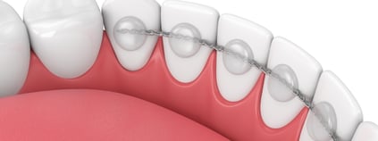 UCSLP artículos ortodoncia_Cuánto cuesta un tratamiento 2