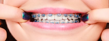 UCSLP artículos ortodoncia_Cuánto cuesta un tratamiento 3