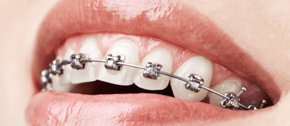UCSLP articulo beneficios de la ortodoncia_1